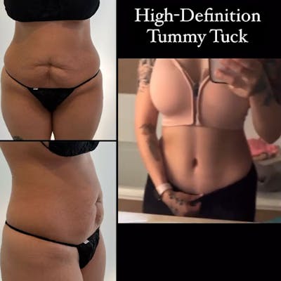 Reels Gallery Before & After Gallery - Patient 123839545 - Image 1