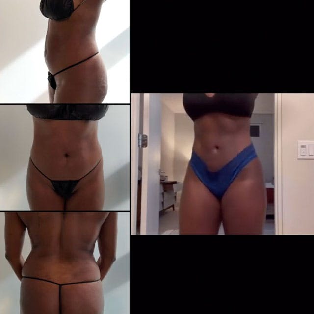 BBL before and after