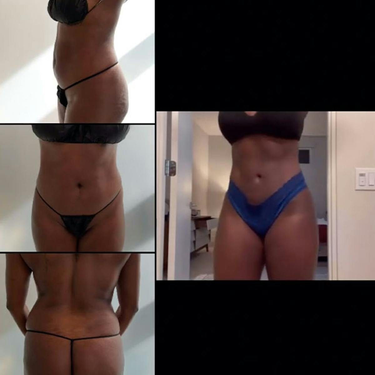 Reels Gallery Before & After Gallery - Patient 123839566 - Image 1