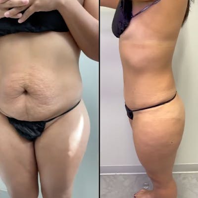 Reels Gallery Before & After Gallery - Patient 123839572 - Image 1