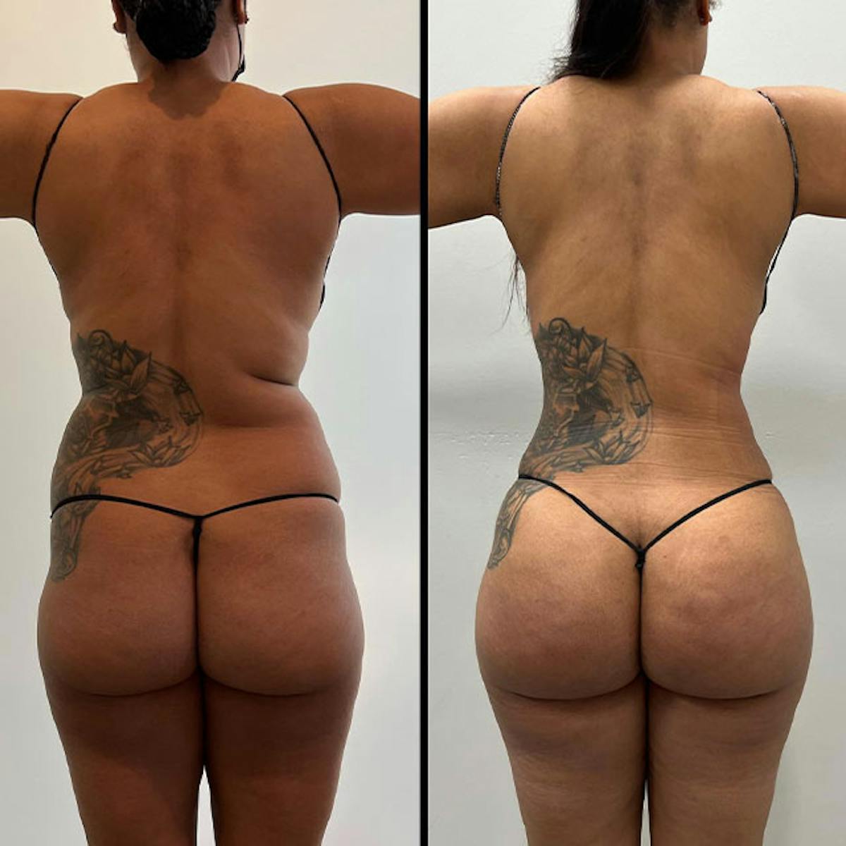 Reels Gallery Before & After Gallery - Patient 123839605 - Image 1