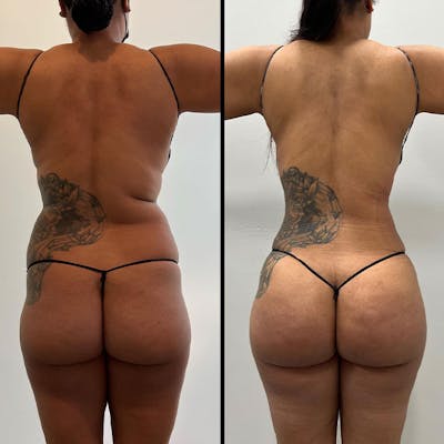 Reels Gallery Before & After Gallery - Patient 123839605 - Image 1