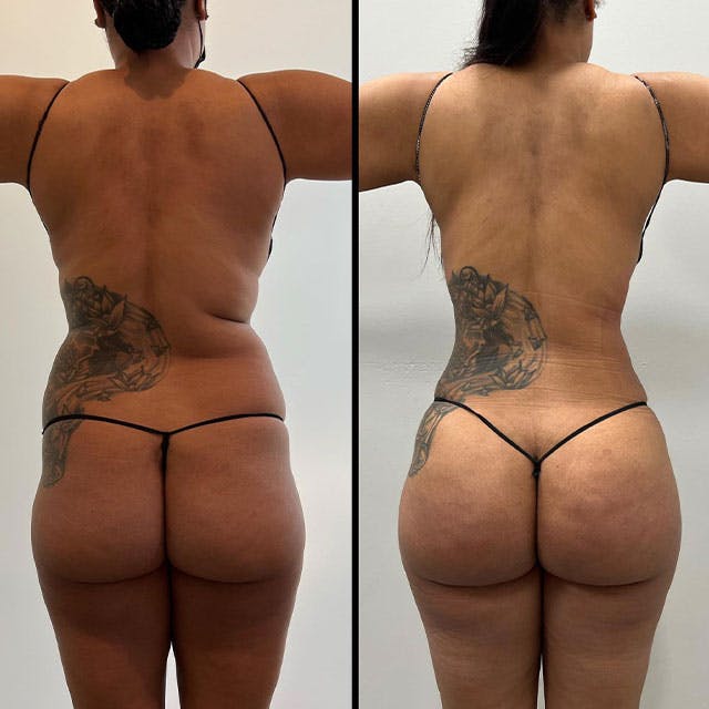 Reels Gallery - Archive of instagram images etc Before & After Gallery - Patient 123839605 - Image 1