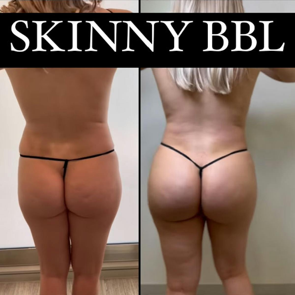 Reels Gallery Before & After Gallery - Patient 140399528 - Image 1