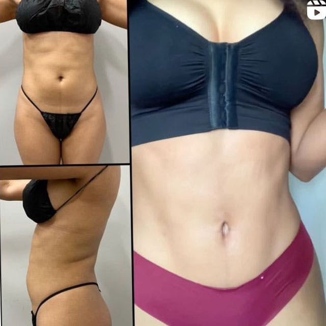 Abdominal etching before and after