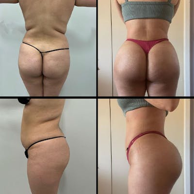 Reels Gallery Before & After Gallery - Patient 140399573 - Image 1