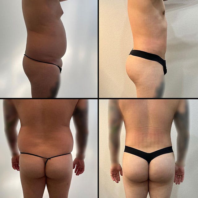 male BBL before and after