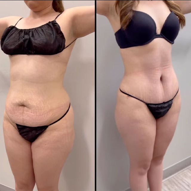 Tummy Tuck before and after