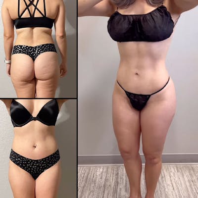 Reels Gallery Before & After Gallery - Patient 142440442 - Image 1