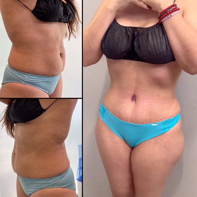 High Definition Tummy Tuck before and after