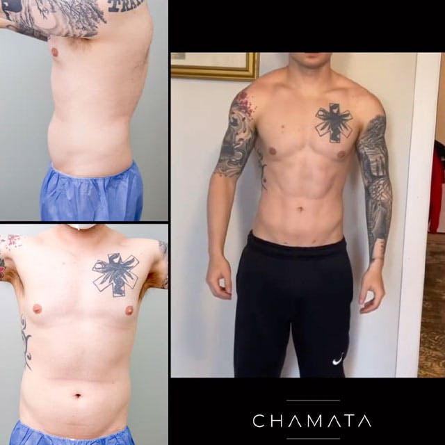male high def lipo before and after