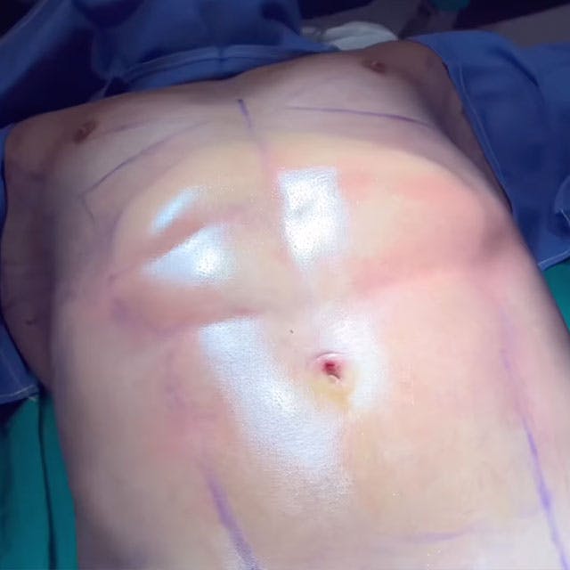 male lipo before and after