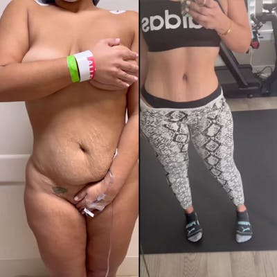 Reels Gallery Before & After Gallery - Patient 146402303 - Image 1