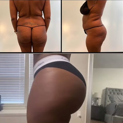 Reels Gallery Before & After Gallery - Patient 146402305 - Image 1