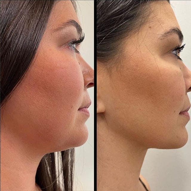 Neck Liposuction before and after