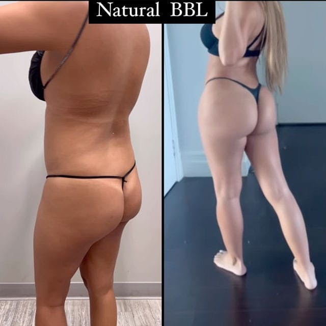 BBL and ab etching before and after