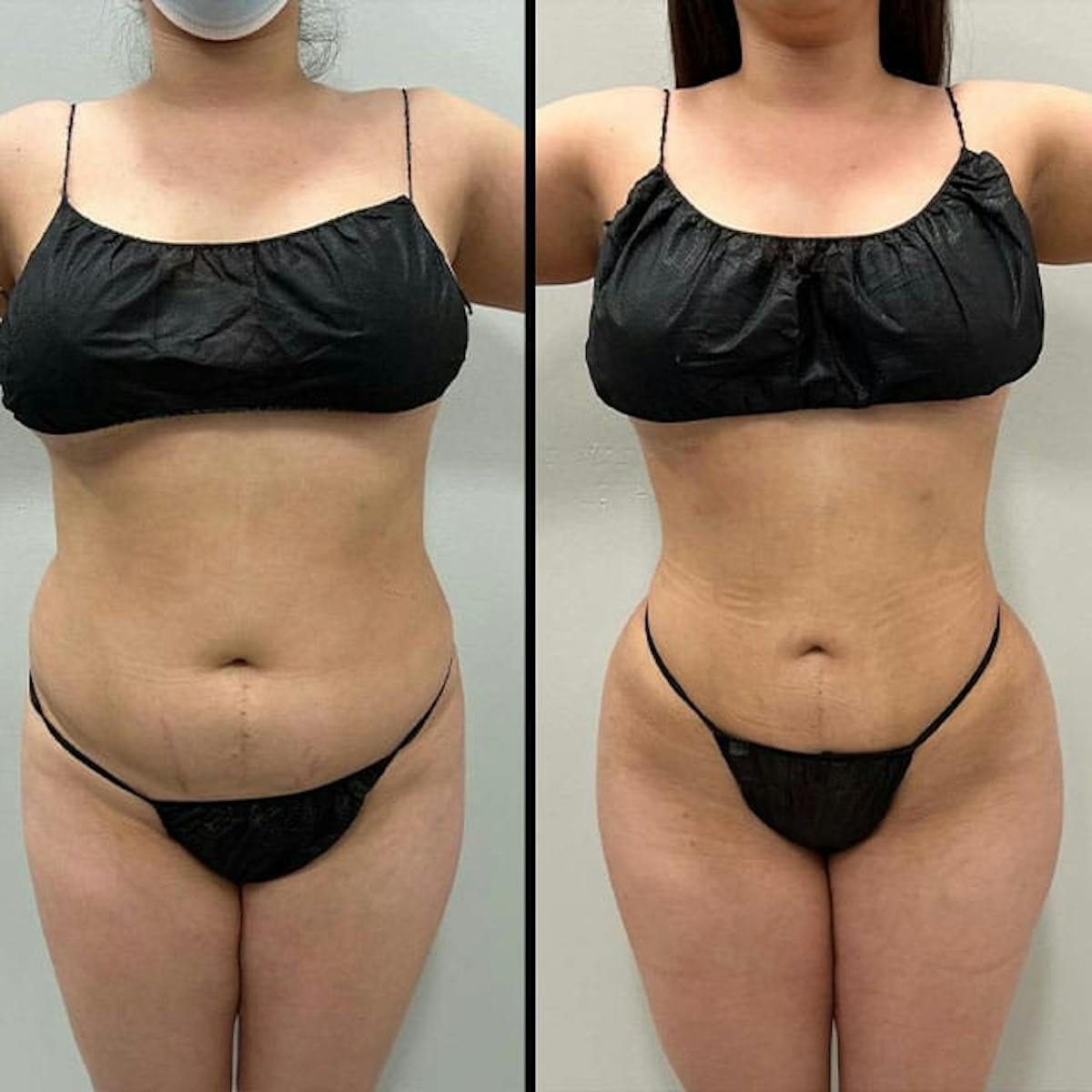 Reels Gallery Before & After Gallery - Patient 146402312 - Image 1