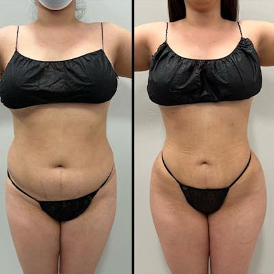 Reels Gallery Before & After Gallery - Patient 146402312 - Image 1