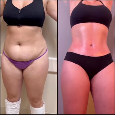 Reels Gallery Before & After Gallery - Patient 217341 - Image 1