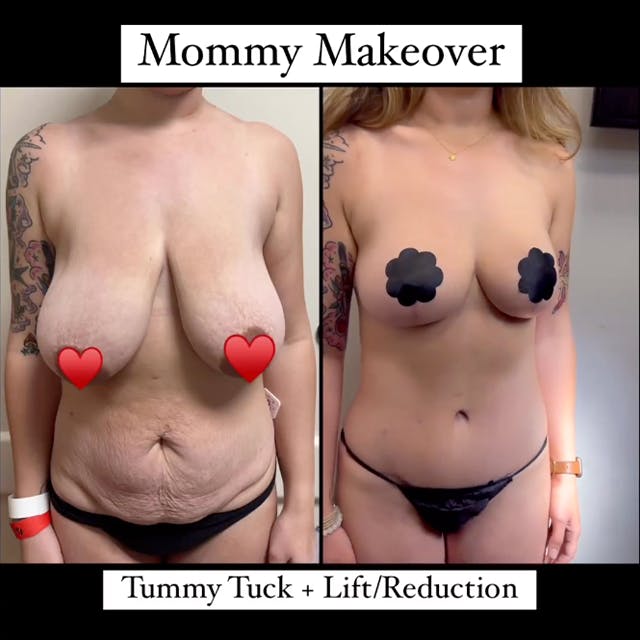 breast lift before and after
