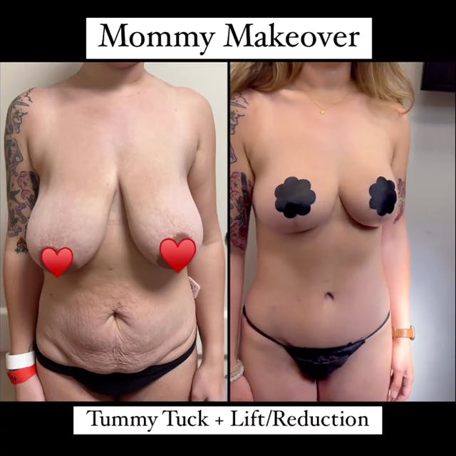 Mommy makeover before and after