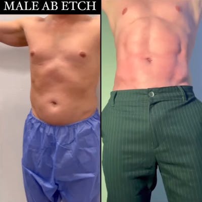 Reels Gallery Before & After Gallery - Patient 329028 - Image 1