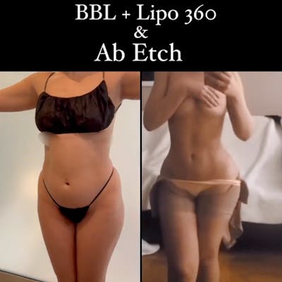 Reels Gallery Before & After Gallery - Patient 133326 - Image 1