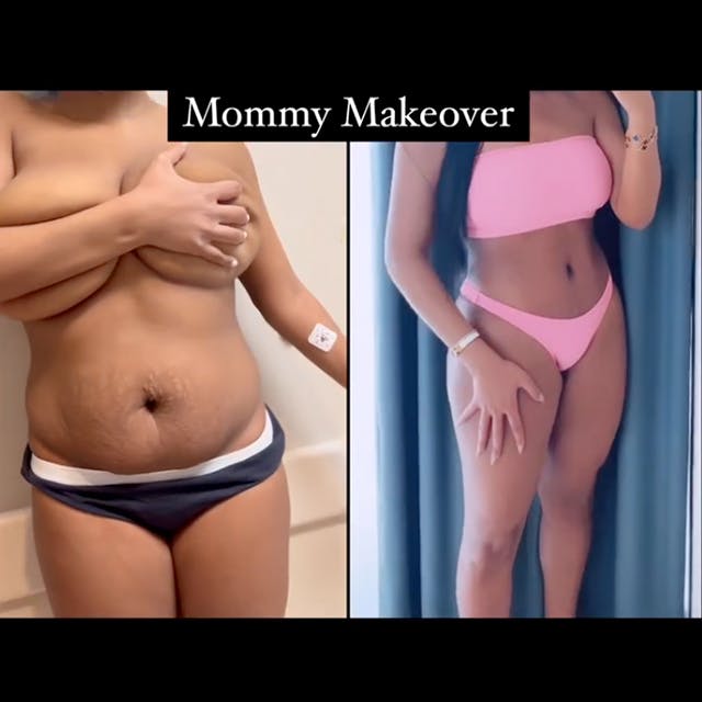 mommy makeover procedure before and after