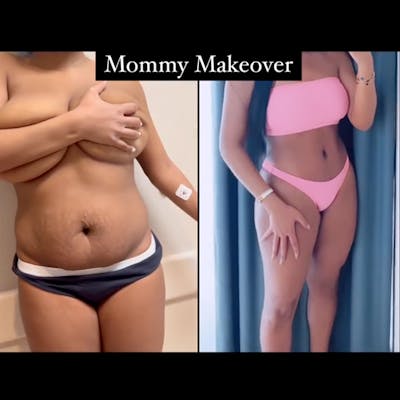 Reels Gallery Before & After Gallery - Patient 684970 - Image 1