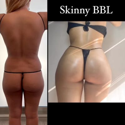 Reels Gallery Before & After Gallery - Patient 142954 - Image 1