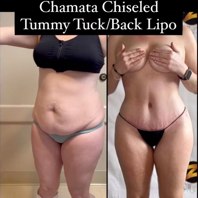 BBL before and after