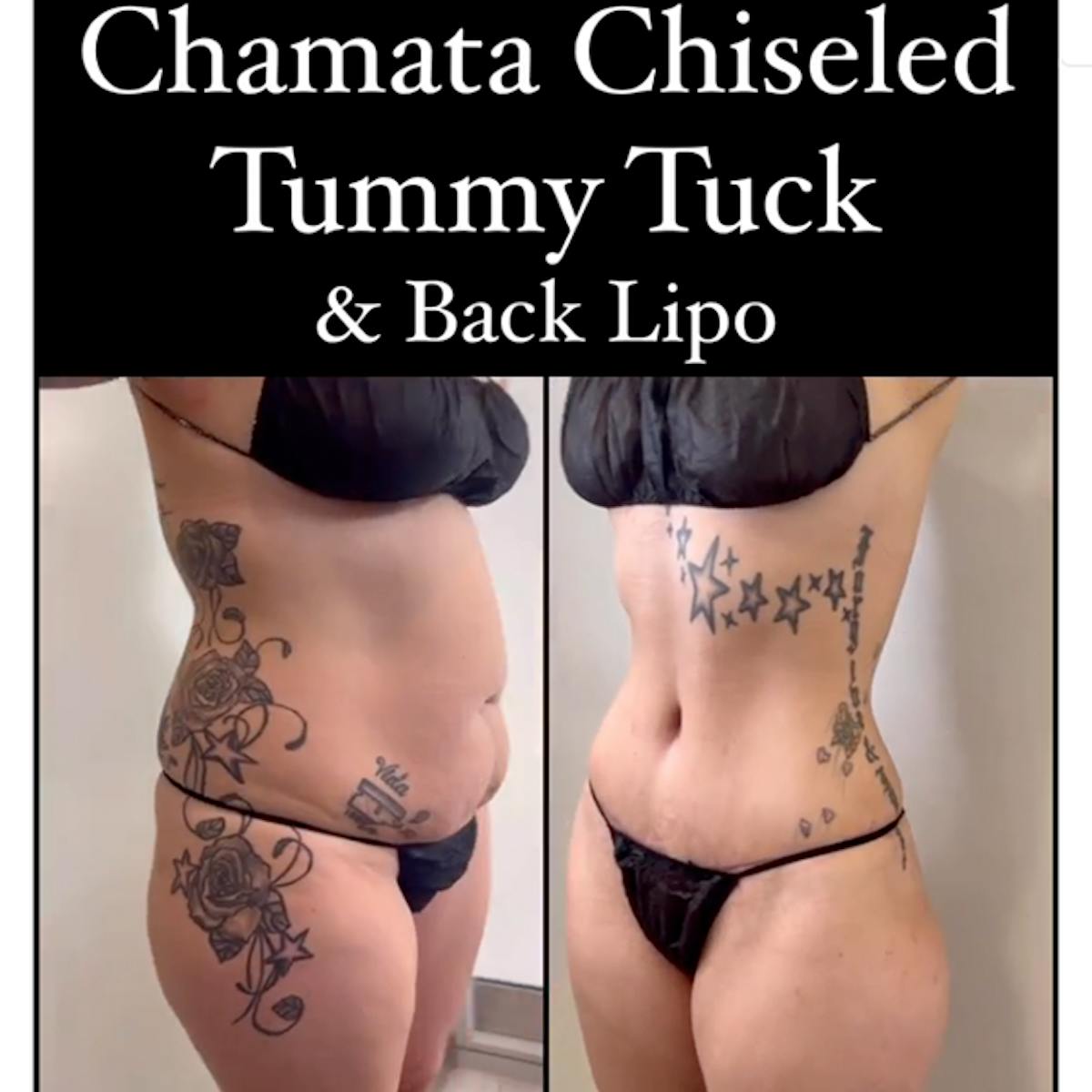 Reels Gallery Before & After Gallery - Patient 217150 - Image 1