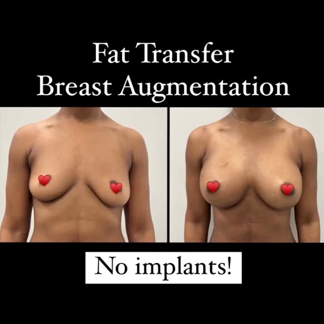 fat transfer breast aug before and after