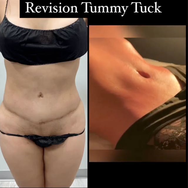 Reels Gallery - Archive of instagram images etc Before & After Gallery - Patient 372975 - Image 1