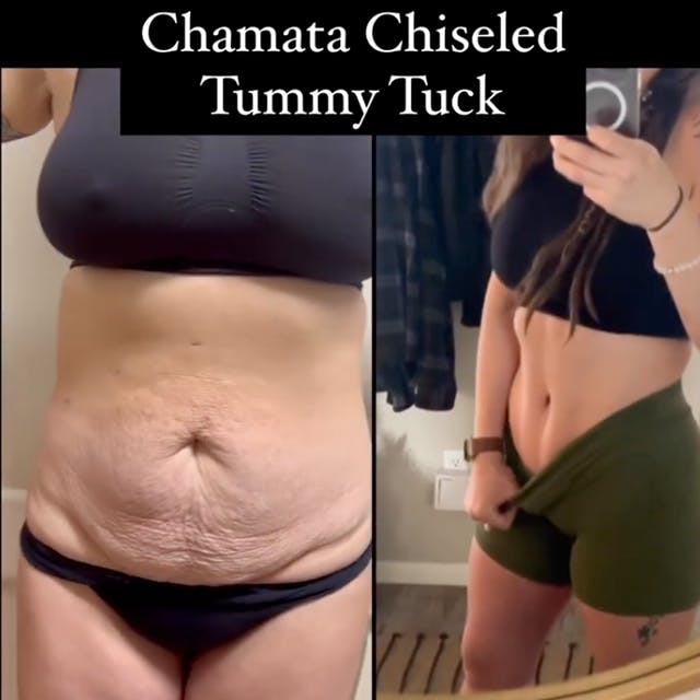 Reels Gallery - Archive of instagram images etc Before & After Gallery - Patient 360039 - Image 1