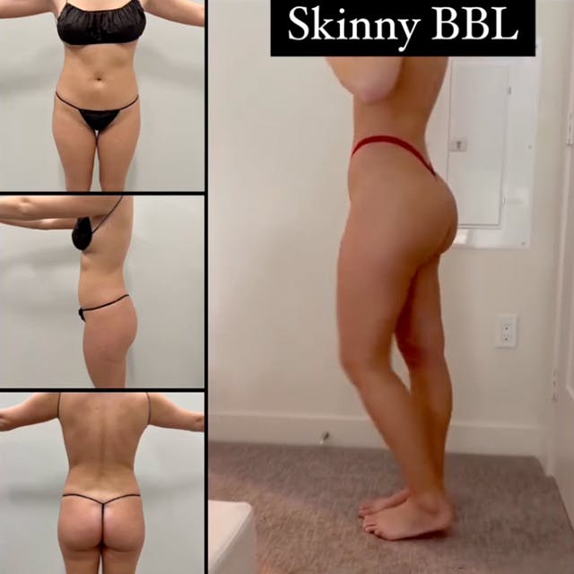 Reels Gallery - Archive of instagram images etc Before & After Gallery - Patient 164487 - Image 1