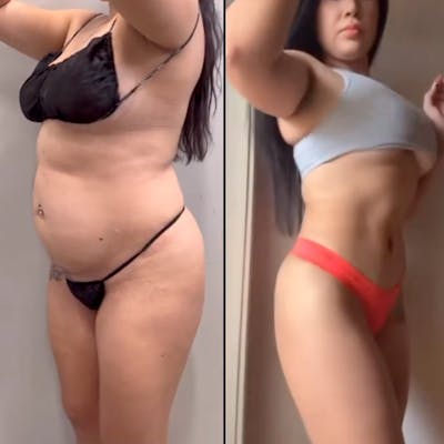 Reels Gallery Before & After Gallery - Patient 281713 - Image 1