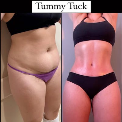 Reels Gallery Before & After Gallery - Patient 327177 - Image 1