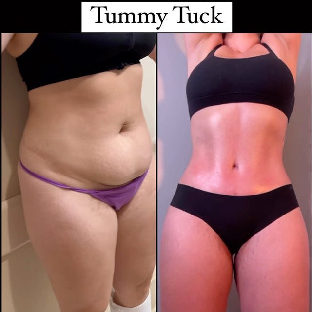 Reels Gallery - Archive of instagram images etc Before & After Gallery - Patient 327177 - Image 1