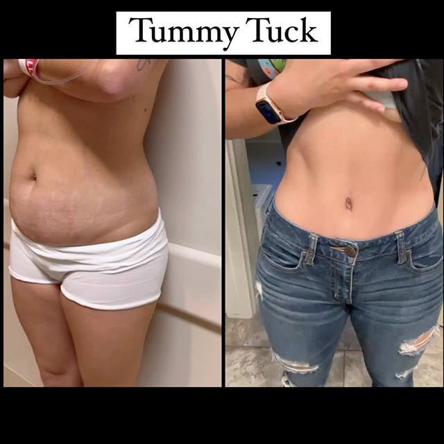 Reels Gallery - Archive of instagram images etc Before & After Gallery - Patient 217321 - Image 1