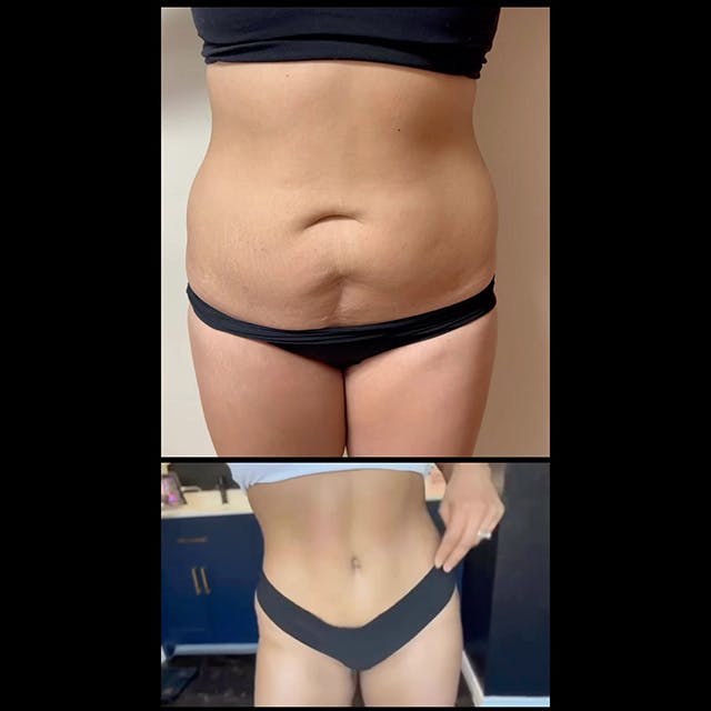 Reels Gallery - Archive of instagram images etc Before & After Gallery - Patient 226569 - Image 1