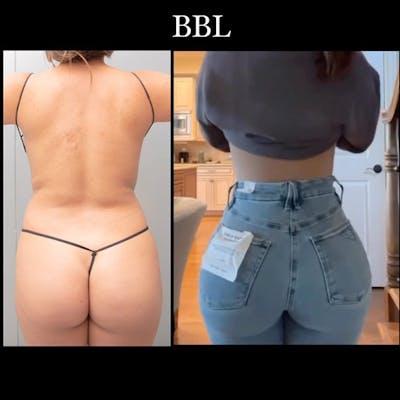 Reels Gallery Before & After Gallery - Patient 402197 - Image 1