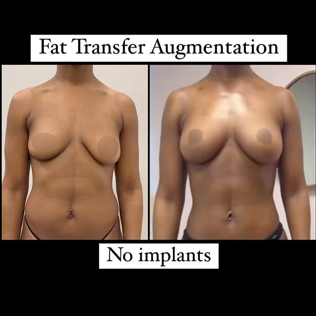 Reels Gallery - Archive of instagram images etc Before & After Gallery - Patient 218482 - Image 1