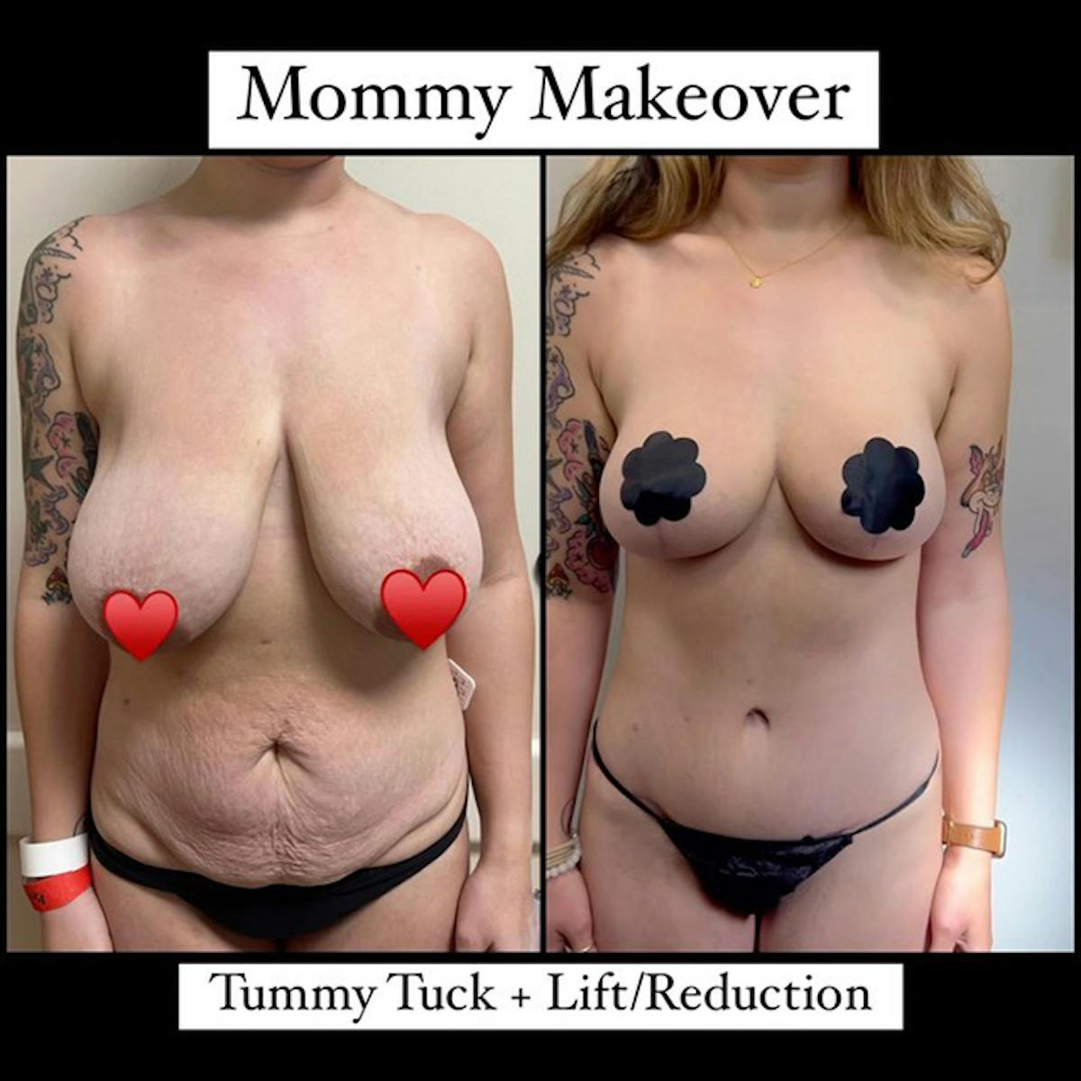 Reels Gallery Before & After Gallery - Patient 167544 - Image 1