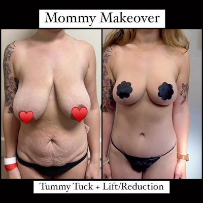 Reels Gallery Before & After Gallery - Patient 167544 - Image 1