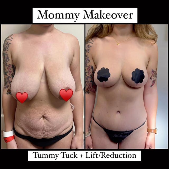 Reels Gallery - Archive of instagram images etc Before & After Gallery - Patient 167544 - Image 1