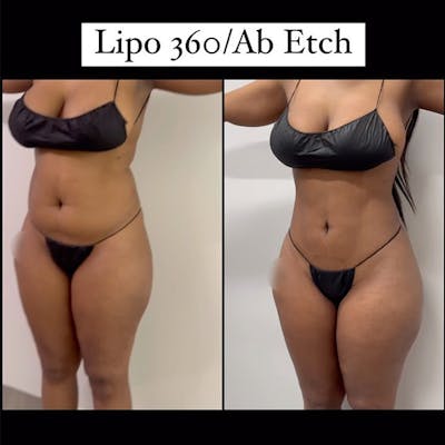 Reels Gallery Before & After Gallery - Patient 559684 - Image 1