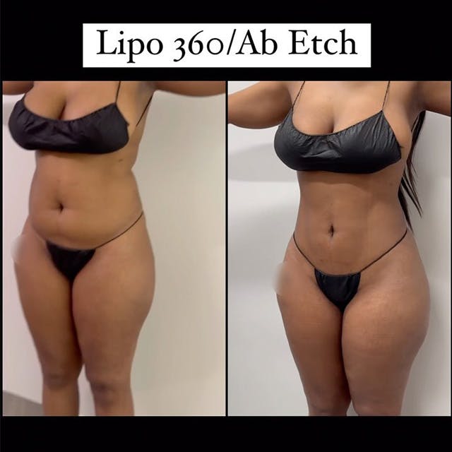 Reels Gallery - Archive of instagram images etc Before & After Gallery - Patient 559684 - Image 1