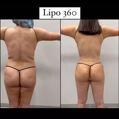 Reels Gallery Before & After Gallery - Patient 132106 - Image 1