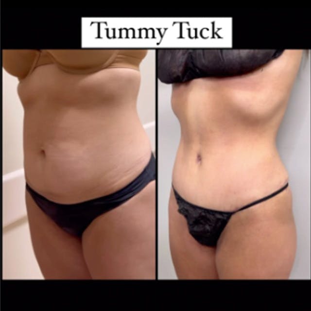 Reels Gallery - Archive of instagram images etc Before & After Gallery - Patient 435398 - Image 1